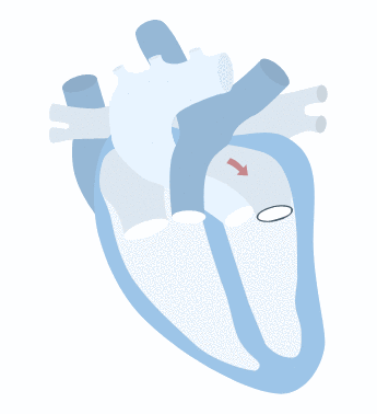 Mitral regurgitation