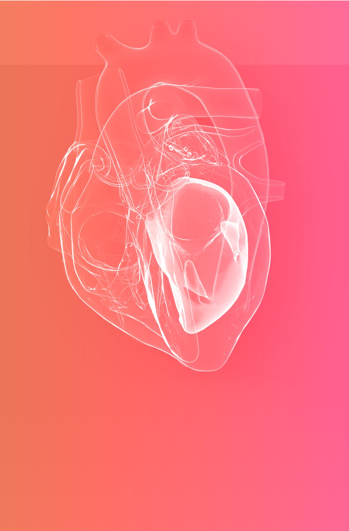 Atrial fibrillation